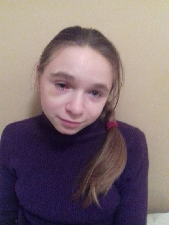 Дівчинка може втратити зір: у Черкаській області просять допомогти дитині